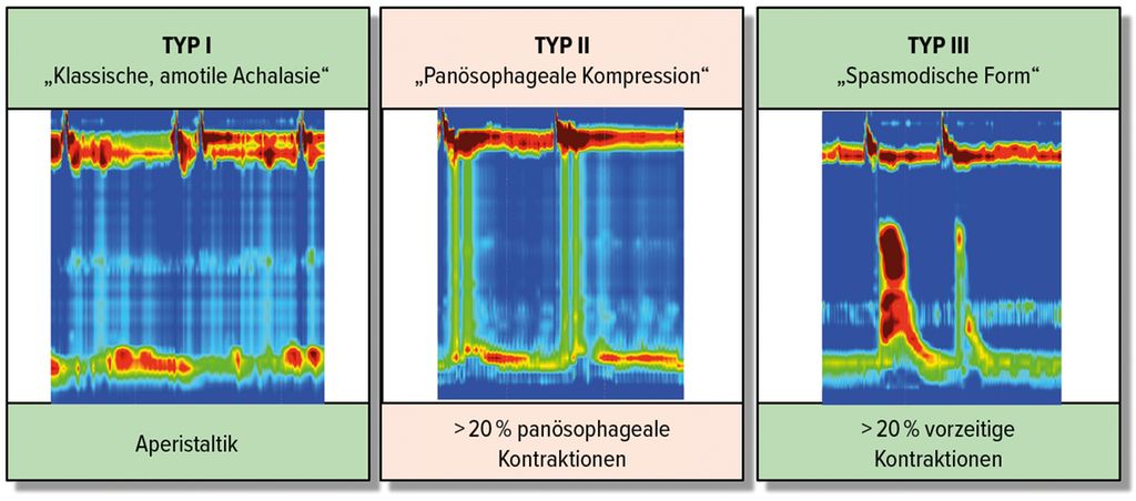 Achalasie Welche Therapie Für Welchen Patienten Gastroenterologie Universimed Medizin Im 2340